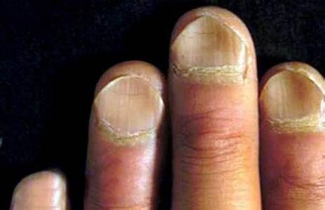指甲凹陷的手相好吗 　　一、指甲凹陷代表健康状况不好