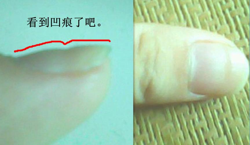 指甲内陷的手相 　　一、指甲内陷影响健康