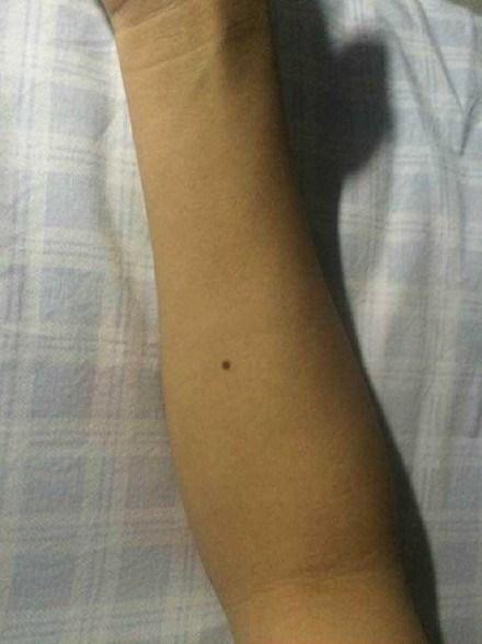 手臂朱砂痣有什么含义 上臂外侧有痣，随机应变