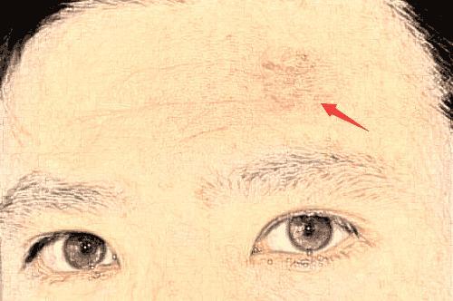 眼睛周围有伤疤的人有福气 左眼睛上有疤痕的人事业发展崎岖坎坷