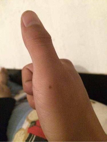 右手大拇指有痣代表什么 大拇指短小与有痣有影响吗