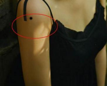 女人手臂各种痣图解 畅达痣:长在肩膀头部的区域