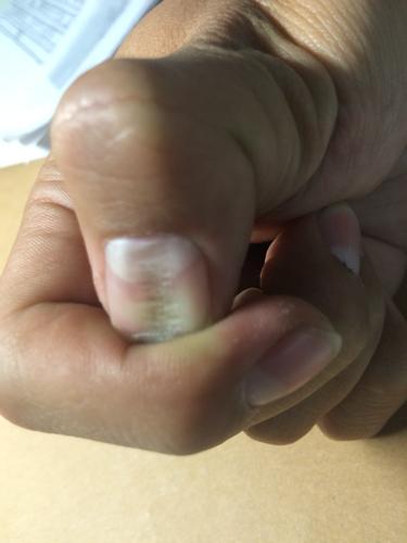 大拇指横纹多代表什么 大拇指横纹反映健康问题