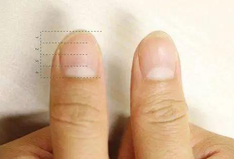 手指小太阳代表什么 什么叫手指上小太阳