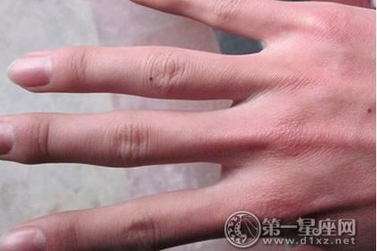 手指上朱砂痣的位置和命运 手指长有朱砂痣代表什么