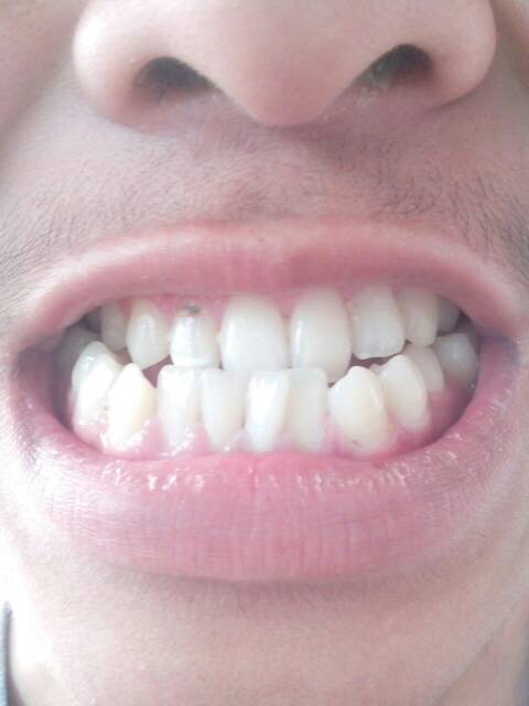 从牙齿不整齐的人性格可以看出什么 牙齿不整齐暴露个性急躁
